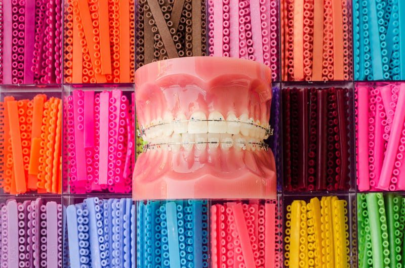 Modelo de ortodoncia con brackets